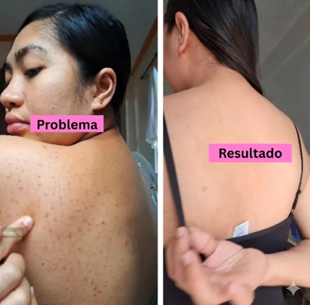 BACK ACNE Elimina el acné corporal