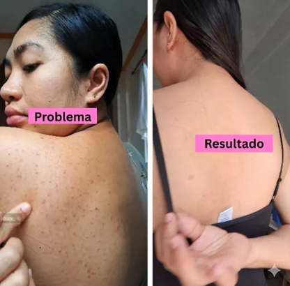 BACK ACNE Elimina el acné corporal